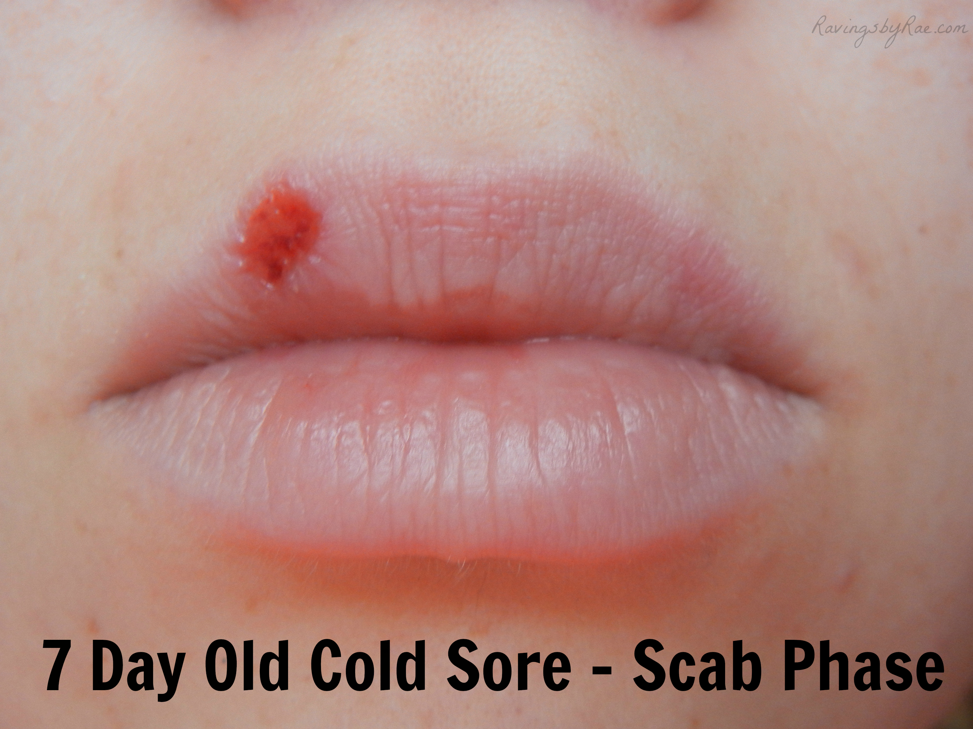 How Often Should I Put Abreva On My Cold Sore